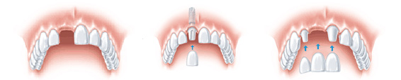 歯槽堤増大術