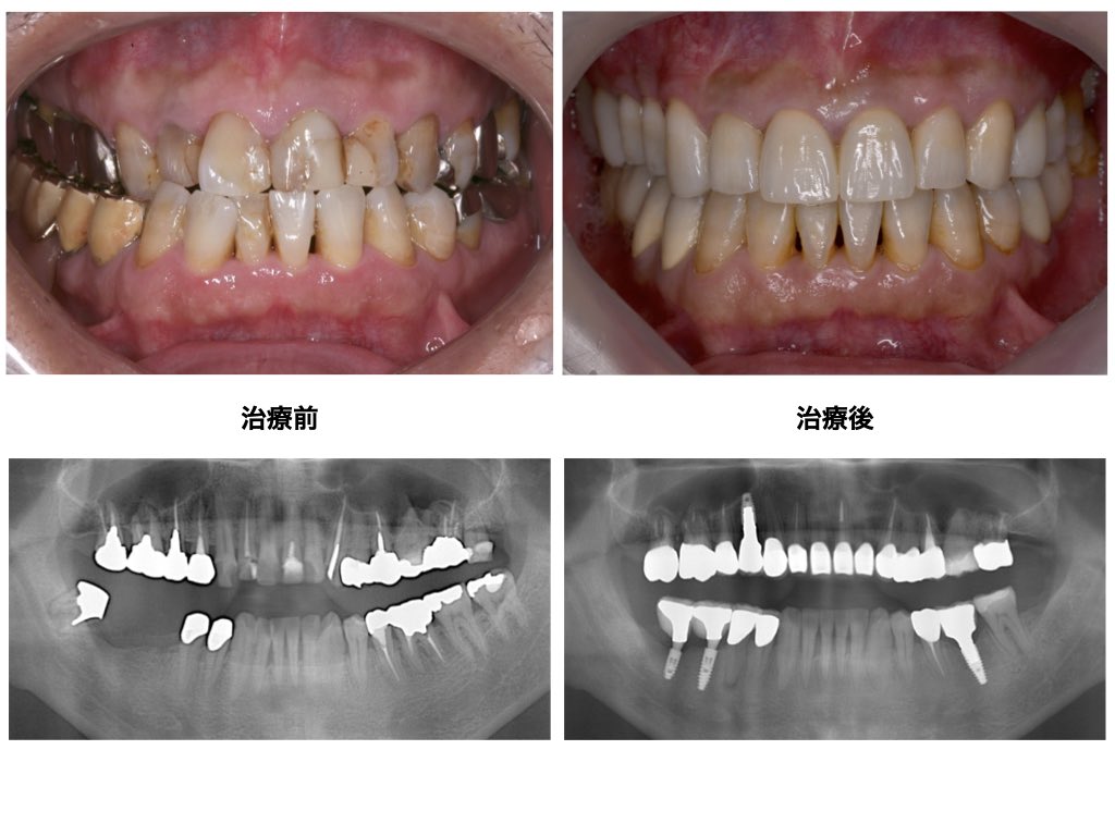 インプラント＋矯正＋オールセラミックの症例~50代男性~