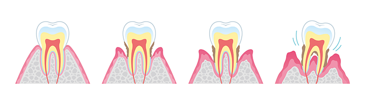 歯周病