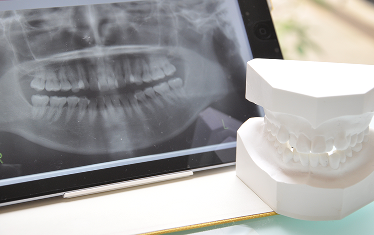 インプラント術前検査と仮義歯