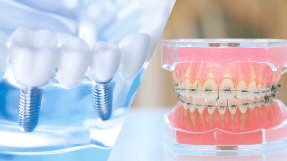 インプラント 矯正治療